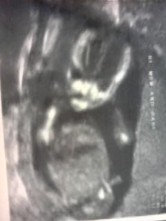 My future niece / nephew - See this image on Photobucket.