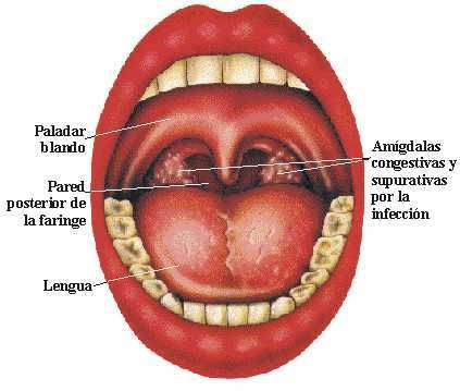 amigdale inflamate